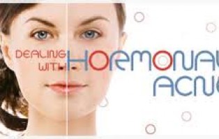 My Skin Won’t Stop Me: Adult Hormonal Acne