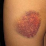 My skin won’t stop me!!!