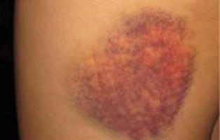 My skin won’t stop me!!!